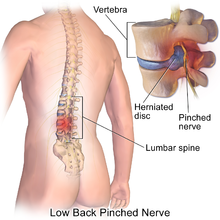 Herniated-Lumbar-Disc-pinched-nerve