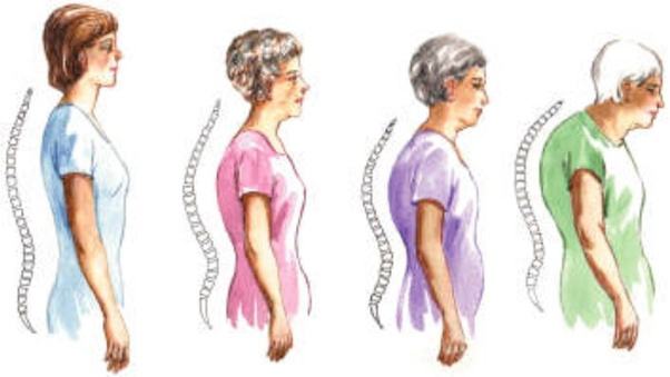 aging-and-body-back-deformation-in-grown-and-aging-people