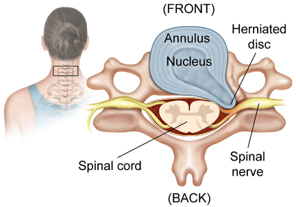 cervical-herniated-disc-cervical-disease