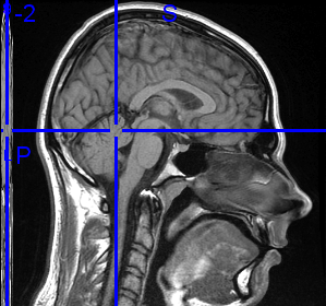 RMI scan of hip0 brain